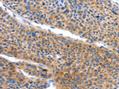 The image on the left is immunohistochemistry of paraffin-embedded Human liver cancer tissue using CSB-PA054255(ARL11 Antibody) at dilution 1/50, on the right is treated with fusion protein. (Original magnification: ×200)
