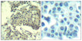 Immunohistochemical analysis of paraffin-embedded human breast carcinoma tissue using mTOR(Ab-2481) Antibody(left) or the same antibody preincubated with blocking peptide(right).