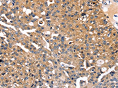 The image on the left is immunohistochemistry of paraffin-embedded Human breast cancer tissue using CSB-PA054783(SLC2A2 Antibody) at dilution 1/35, on the right is treated with synthetic peptide. (Original magnification: ×200)