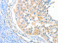 The image on the left is immunohistochemistry of paraffin-embedded Human breast cancer tissue using CSB-PA055199(DUSP14 Antibody) at dilution 1/20, on the right is treated with fusion protein. (Original magnification: ×200)