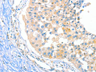 The image on the left is immunohistochemistry of paraffin-embedded Human breast cancer tissue using CSB-PA055199(DUSP14 Antibody) at dilution 1/20, on the right is treated with fusion protein. (Original magnification: ×200)