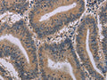 The image on the left is immunohistochemistry of paraffin-embedded Human colon cancer tissue using CSB-PA055681(ACVR2A Antibody) at dilution 1/20, on the right is treated with synthetic peptide. (Original magnification: ×200)