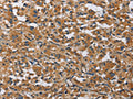 The image on the left is immunohistochemistry of paraffin-embedded Human thyroid cancer tissue using CSB-PA055744(BMP15 Antibody) at dilution 1/40, on the right is treated with fusion protein. (Original magnification: ×200)