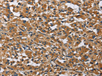 The image on the left is immunohistochemistry of paraffin-embedded Human thyroid cancer tissue using CSB-PA055744(BMP15 Antibody) at dilution 1/40, on the right is treated with fusion protein. (Original magnification: ×200)