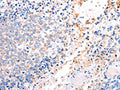 The image on the left is immunohistochemistry of paraffin-embedded Human ovarian cancer tissue using CSB-PA055934(ACAD9 Antibody) at dilution 1/15, on the right is treated with fusion protein. (Original magnification: ×200)