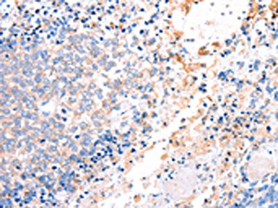 The image on the left is immunohistochemistry of paraffin-embedded Human ovarian cancer tissue using CSB-PA055934(ACAD9 Antibody) at dilution 1/15, on the right is treated with fusion protein. (Original magnification: ×200)