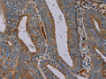 The image on the left is immunohistochemistry of paraffin-embedded Human colon cancer tissue using CSB-PA056057(PYY Antibody) at dilution 1/40, on the right is treated with synthetic peptide. (Original magnification: ×200)