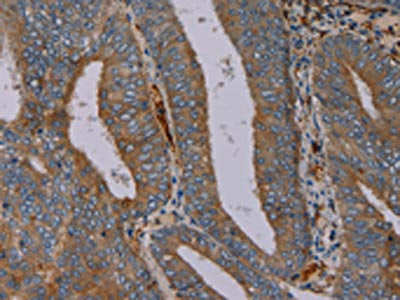 The image on the left is immunohistochemistry of paraffin-embedded Human colon cancer tissue using CSB-PA056057(PYY Antibody) at dilution 1/40, on the right is treated with synthetic peptide. (Original magnification: ×200)