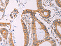 The image on the left is immunohistochemistry of paraffin-embedded Human colon cancer tissue using CSB-PA056130(ADCY1 Antibody) at dilution 1/60, on the right is treated with synthetic peptide. (Original magnification: ×200)