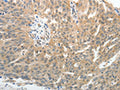 The image on the left is immunohistochemistry of paraffin-embedded Human ovarian cancer tissue using CSB-PA056380(SELE Antibody) at dilution 1/40, on the right is treated with fusion protein. (Original magnification: ×200)