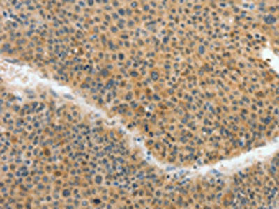 The image on the left is immunohistochemistry of paraffin-embedded Human liver cancer tissue using CSB-PA056430(ACLY Antibody) at dilution 1/40, on the right is treated with fusion protein. (Original magnification: ×200)