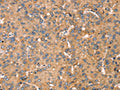 The image on the left is immunohistochemistry of paraffin-embedded Human liver cancer tissue using CSB-PA056705(TGFB2 Antibody) at dilution 1/30, on the right is treated with synthetic peptide. (Original magnification: ×200)