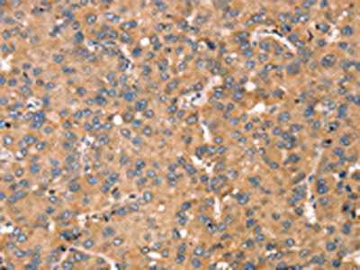 The image on the left is immunohistochemistry of paraffin-embedded Human liver cancer tissue using CSB-PA056705(TGFB2 Antibody) at dilution 1/30, on the right is treated with synthetic peptide. (Original magnification: ×200)