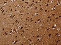The image on the left is immunohistochemistry of paraffin-embedded Human brain tissue using CSB-PA056745(KARS Antibody) at dilution 1/30, on the right is treated with fusion protein. (Original magnification: ×200)