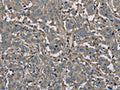 The image on the left is immunohistochemistry of paraffin-embedded Human liver cancer tissue using CSB-PA056820(FBP1 Antibody) at dilution 1/30, on the right is treated with fusion protein. (Original magnification: ×200)