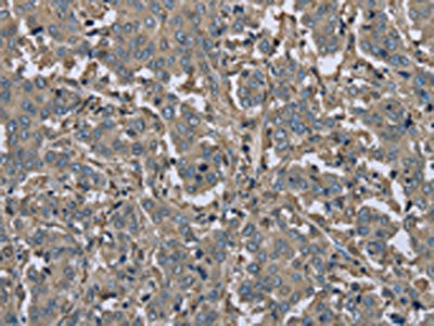 The image on the left is immunohistochemistry of paraffin-embedded Human liver cancer tissue using CSB-PA056820(FBP1 Antibody) at dilution 1/30, on the right is treated with fusion protein. (Original magnification: ×200)