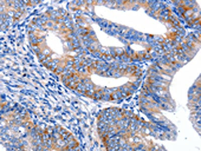 The image on the left is immunohistochemistry of paraffin-embedded Human cervical cancer tissue using CSB-PA056943(AR Antibody) at dilution 1/20, on the right is treated with synthetic peptide. (Original magnification: ×200)