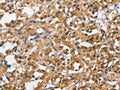 The image on the left is immunohistochemistry of paraffin-embedded Human thyroid cancer tissue using CSB-PA057007(BCL10 Antibody) at dilution 1/40, on the right is treated with fusion protein. (Original magnification: ×200)