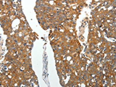 The image on the left is immunohistochemistry of paraffin-embedded Human breast cancer tissue using CSB-PA057038(ROCK1 Antibody) at dilution 1/25, on the right is treated with fusion protein. (Original magnification: ×200)