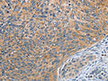 The image on the left is immunohistochemistry of paraffin-embedded Human cervical cancer tissue using CSB-PA057264(SPIRE2 Antibody) at dilution 1/30, on the right is treated with fusion protein. (Original magnification: ×200)