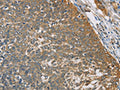 The image on the left is immunohistochemistry of paraffin-embedded Human cervical cancer tissue using CSB-PA057438(TNFRSF10D Antibody) at dilution 1/40, on the right is treated with fusion protein. (Original magnification: ×200)