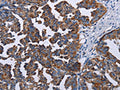 The image on the left is immunohistochemistry of paraffin-embedded Human ovarian cancer tissue using CSB-PA057546(TRIM13 Antibody) at dilution 1/30, on the right is treated with fusion protein. (Original magnification: ×200)