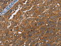 The image on the left is immunohistochemistry of paraffin-embedded Human ovarian cancer tissue using CSB-PA057722(ADAMTS15 Antibody) at dilution 1/40, on the right is treated with fusion protein. (Original magnification: ×200)