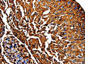The image on the left is immunohistochemistry of paraffin-embedded Human lung cancer tissue using CSB-PA057752(PKM Antibody) at dilution 1/50, on the right is treated with fusion protein. (Original magnification: ×200)