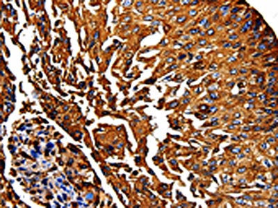 The image on the left is immunohistochemistry of paraffin-embedded Human lung cancer tissue using CSB-PA057752(PKM Antibody) at dilution 1/50, on the right is treated with fusion protein. (Original magnification: ×200)