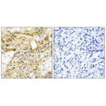 Immunohistochemistry analysis of paraffin-embedded human liver carcinoma tissue using Collagen XVIII α1 antibody.