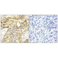 Immunohistochemistry analysis of paraffin-embedded human liver carcinoma tissue using Collagen XVIII α1 antibody.