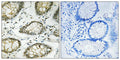 Immunohistochemistry analysis of paraffin-embedded human colon carcinoma tissue using ATR (Phospho-Ser428) antibody. The picture on the right is treated with the synthesized peptide.