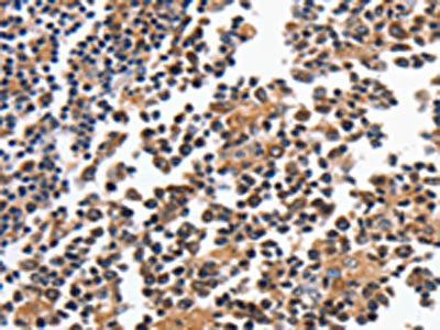 The image on the left is immunohistochemistry of paraffin-embedded Human tonsil tissue using CSB-PA059198(MAGEA4 Antibody) at dilution 1/20, on the right is treated with fusion protein. (Original magnification: ×200)