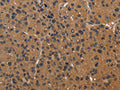 The image on the left is immunohistochemistry of paraffin-embedded Human liver cancer tissue using CSB-PA059743(ICAM4 Antibody) at dilution 1/50, on the right is treated with fusion protein. (Original magnification: ×200)