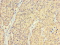 Immunohistochemistry of paraffin-embedded human ovarian cancer using CSB-PA05979A0Rb at dilution of 1:100