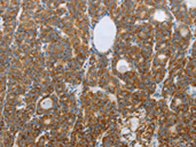 The image on the left is immunohistochemistry of paraffin-embedded Human thyroid cancer tissue using CSB-PA059841(RNF126 Antibody) at dilution 1/20, on the right is treated with synthetic peptide. (Original magnification: ×200)