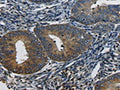 The image on the left is immunohistochemistry of paraffin-embedded Human cervical cancer tissue using CSB-PA060417(CTGF Antibody) at dilution 1/50, on the right is treated with synthetic peptide. (Original magnification: ×200)