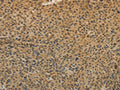 The image on the left is immunohistochemistry of paraffin-embedded Human liver cancer tissue using CSB-PA060587(TGFB1 Antibody) at dilution 1/20, on the right is treated with fusion protein. (Original magnification: ×200)