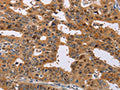 The image on the left is immunohistochemistry of paraffin-embedded Human gastic cancer tissue using CSB-PA061258(NIF3L1 Antibody) at dilution 1/30, on the right is treated with fusion protein. (Original magnification: ×200)