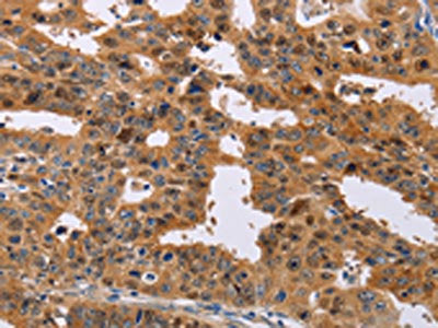 The image on the left is immunohistochemistry of paraffin-embedded Human gastic cancer tissue using CSB-PA061258(NIF3L1 Antibody) at dilution 1/30, on the right is treated with fusion protein. (Original magnification: ×200)