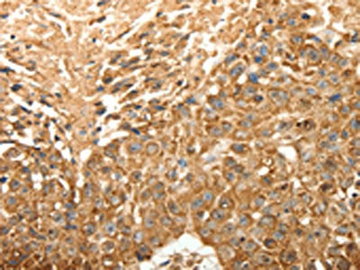 The image on the left is immunohistochemistry of paraffin-embedded Human esophagus cancer tissue using CSB-PA061492(SLC25A11 Antibody) at dilution 1/30, on the right is treated with fusion protein. (Original magnification: ×200)