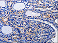 The image on the left is immunohistochemistry of paraffin-embedded Human thyroid cancer tissue using CSB-PA061493(CAMK2B Antibody) at dilution 1/10, on the right is treated with fusion protein. (Original magnification: ×200)