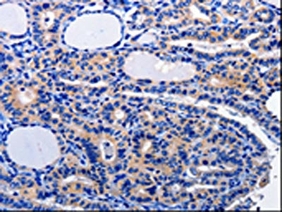 The image on the left is immunohistochemistry of paraffin-embedded Human thyroid cancer tissue using CSB-PA061493(CAMK2B Antibody) at dilution 1/10, on the right is treated with fusion protein. (Original magnification: ×200)