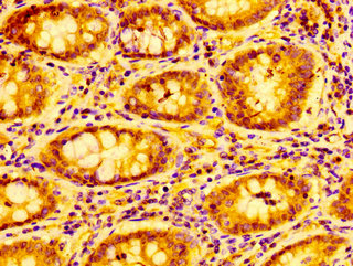 IHC image of CSB-PA06189A0Rb diluted at 1:100 and staining in paraffin-embedded human colon cancer performed on a Leica BondTM system. After dewaxing and hydration, antigen retrieval was mediated by high pressure in a citrate buffer (pH 6.0). Section was blocked with 10% normal goat serum 30min at RT. Then primary antibody (1% BSA) was incubated at 4&deg;C overnight. The primary is detected by a biotinylated secondary antibody and visualized using an HRP conjugated SP system.