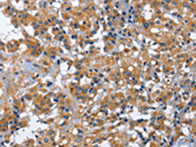 The image on the left is immunohistochemistry of paraffin-embedded Human thyroid cancer tissue using CSB-PA061951(IL2RB Antibody) at dilution 1/30, on the right is treated with fusion protein. (Original magnification: ×200)