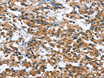 The image on the left is immunohistochemistry of paraffin-embedded Human thyroid cancer tissue using CSB-PA062002(BPI Antibody) at dilution 1/50, on the right is treated with fusion protein. (Original magnification: ×200)