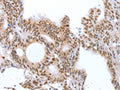 The image on the left is immunohistochemistry of paraffin-embedded Human colon cancer tissue using CSB-PA062537(CTBP2 Antibody) at dilution 1/25, on the right is treated with fusion protein. (Original magnification: ×200)