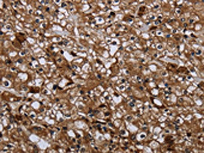 The image on the left is immunohistochemistry of paraffin-embedded Human prostate cancer tissue using CSB-PA063192(GALT Antibody) at dilution 1/40, on the right is treated with fusion protein. (Original magnification: ×200)