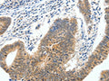 The image on the left is immunohistochemistry of paraffin-embedded Human colon cancer tissue using CSB-PA063282(ECE2 Antibody) at dilution 1/40, on the right is treated with fusion protein. (Original magnification: ×200)