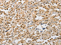 The image on the left is immunohistochemistry of paraffin-embedded Human thyroid cancer tissue using CSB-PA063322(AMZ2 Antibody) at dilution 1/40, on the right is treated with fusion protein. (Original magnification: ×200)